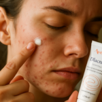 Diacneal Avène : l’émulsion anti-imperfections qui atténue boutons et cicatrices