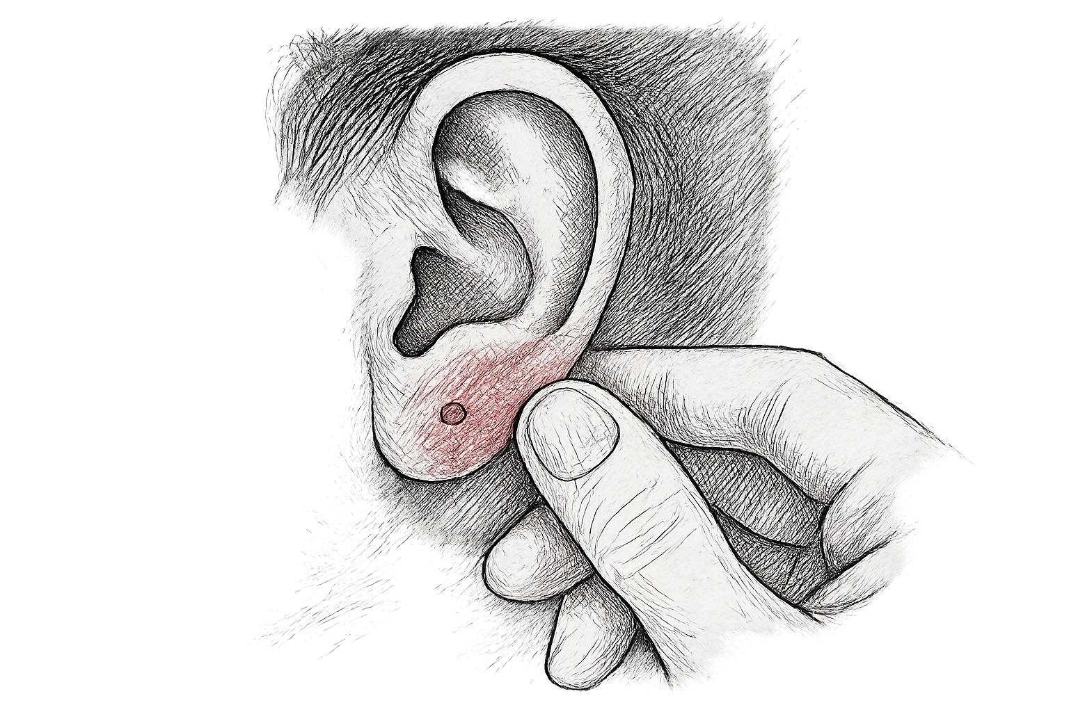 faut il enlever la boucle d'oreille en cas d'infection