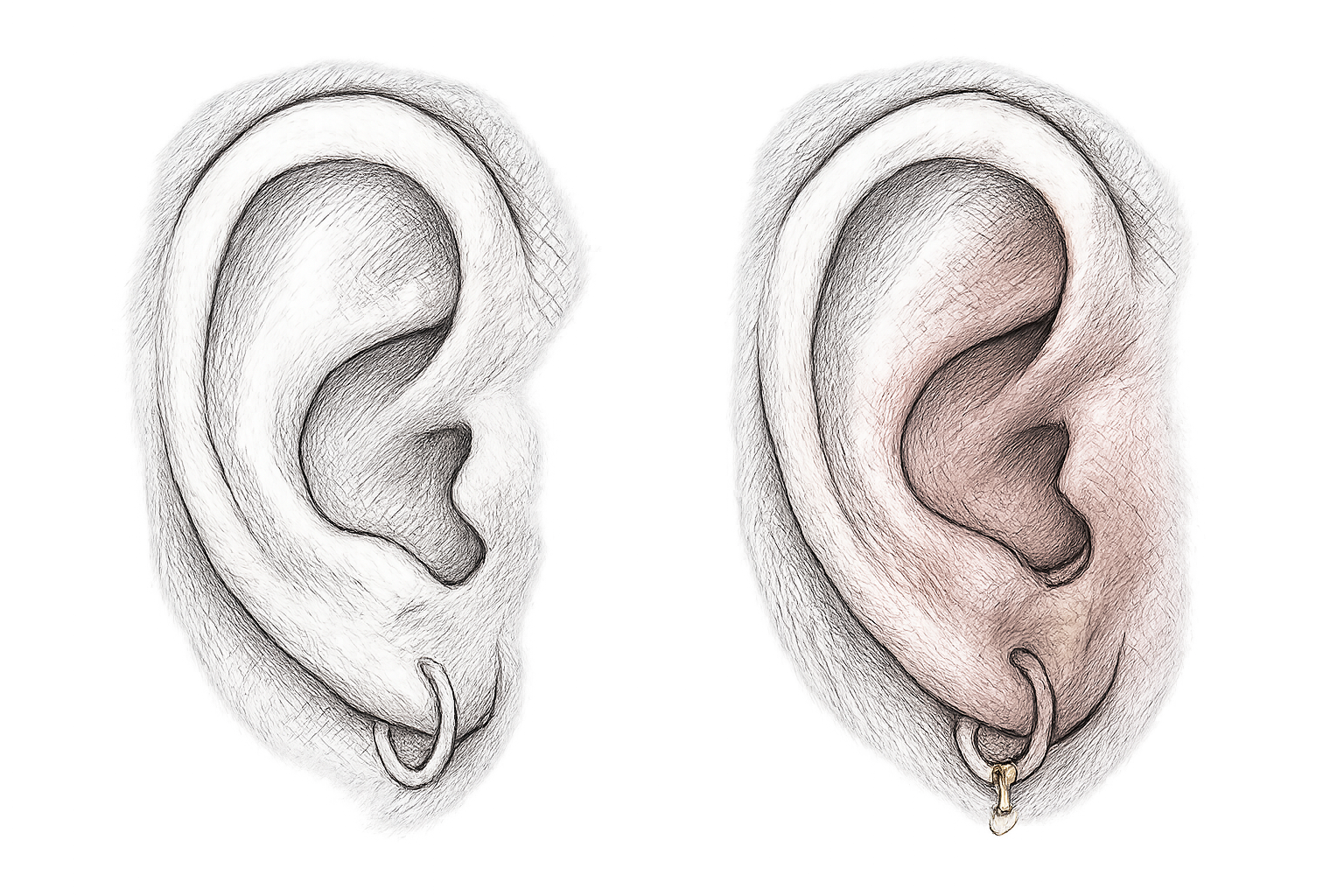 infection daith piercing