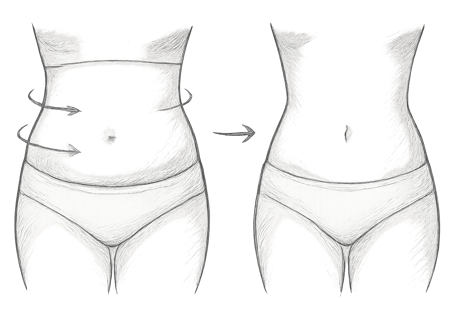 lipocavitation avis