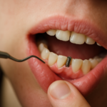 Mini vis orthodontique : témoignage complet sur la pose, la douleur et les résultats en 6 mois