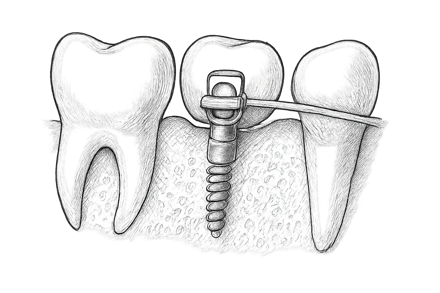 mini vis orthodontique temoignage